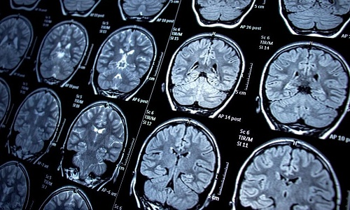 Visualizan por primera vez proteínas iniciadoras del párkinson en el cerebro