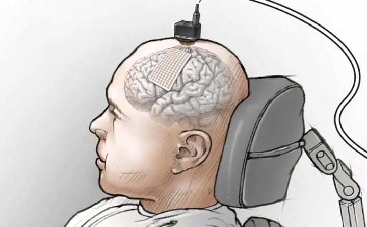Implante cerebral financiado por Facebook permite a persona con parálisis ‘hablar’