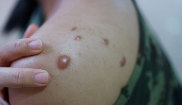 Llegan a siete los casos de viruela símica en Morelos