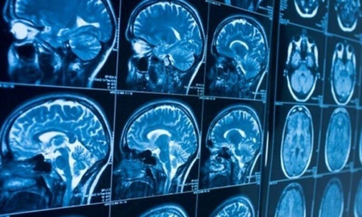 ¿Sabes en qué parte del cerebro se origina la esquizofrenia?
