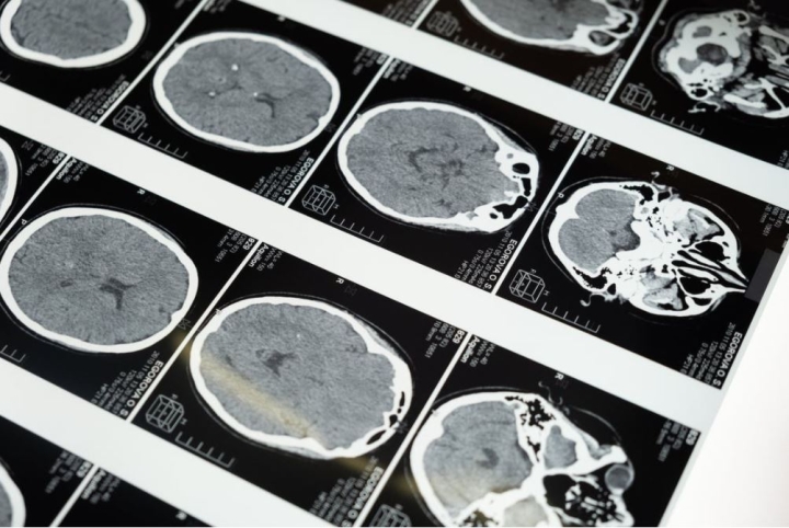 Científicos lograron mapas más detallados del cerebro que ayudarán a tratar la enfermedad de Alzheimer y el Parkinson