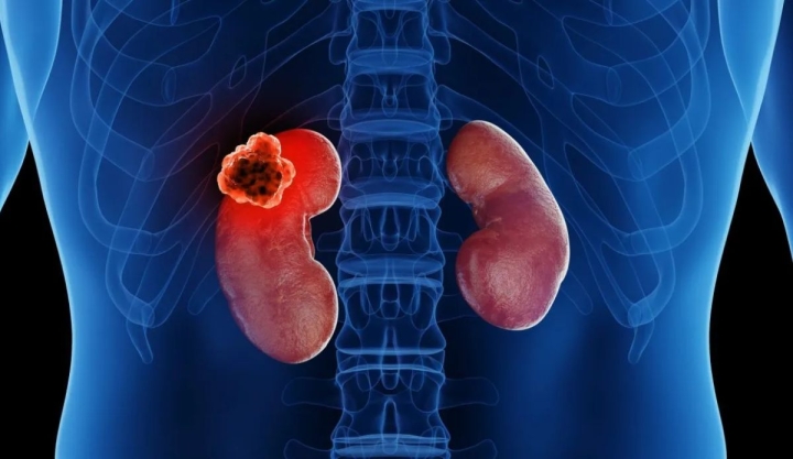 Día Mundial del Cáncer de Riñón