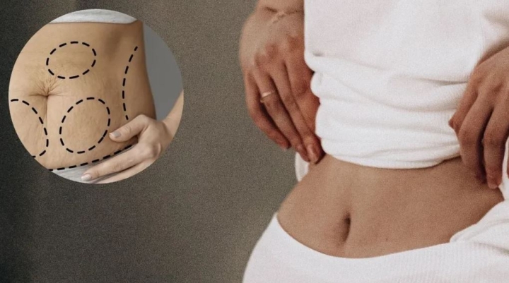 Qué es la abdominoplastia y cuáles son sus riesgos