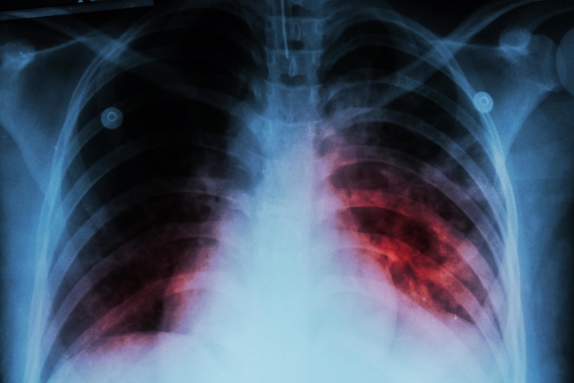 1 millón podrían morir de tuberculosis para 2025: ONU