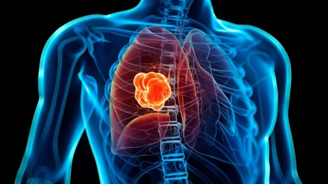 Cáncer de pulmón, más común en hombres