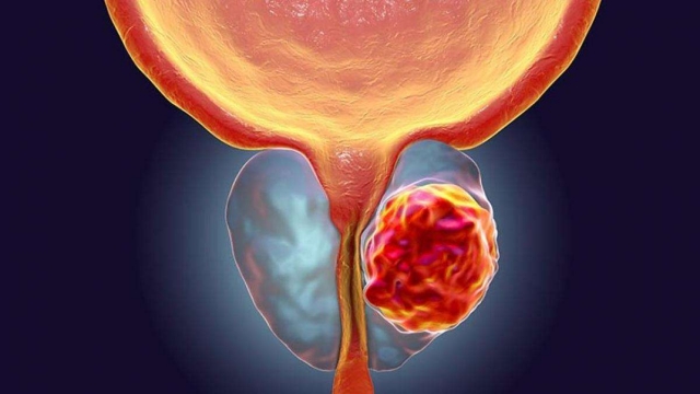 En 2020 se registraron 26 mil nuevos casos de cáncer de próstata en México