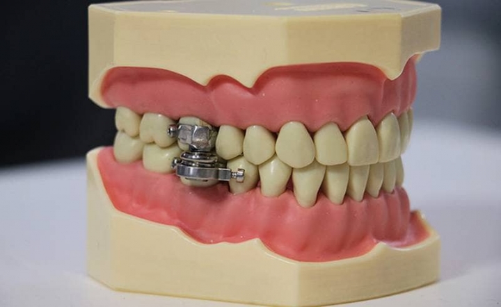 DentalSlim Diet Control es el nombre del dispositivo desarrollado por investigadores de la Universidad de Otago y del Reino Unido. (Universidad de Otago