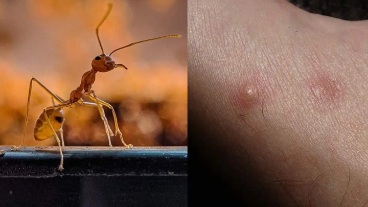 Cómo aliviar las picaduras de hormigas, adiós a la comezón en minutos