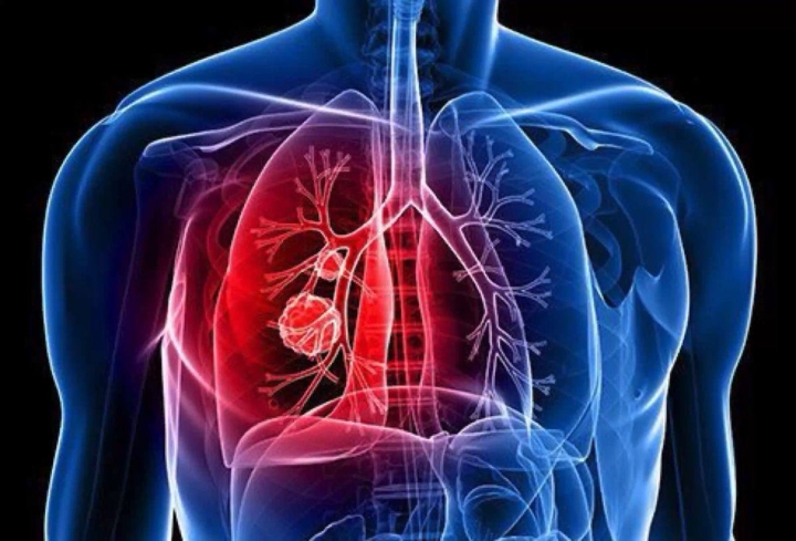 Fibrosis quística: una enfermedad multisistémica que afecta la calidad de vida